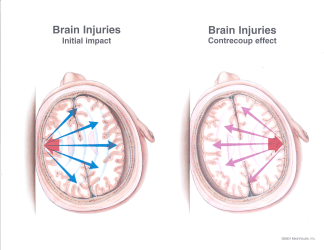 Concussion Traumatic Brain Injury TBI